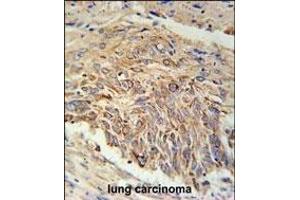 EBPL Antibody (C-term) (ABIN651922 and ABIN2840457) immunohistochemistry analysis in formalin fixed and paraffin embedded human lung carcinoma followed by peroxidase conjugation of the secondary antibody and DAB staining. (EBPL 抗体  (C-Term))