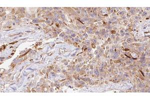 ABIN6278151 at 1/100 staining Human Melanoma tissue by IHC-P. (LGALS1/Galectin 1 抗体)