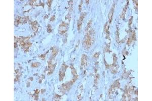 Formalin-fixed, paraffin-embedded human ovarian carcinoma stained. (TDRKH 抗体)