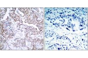 Immunohistochemistry analysis of paraffin-embedded human breast carcinoma, using p53 (Phospho-Ser15) Antibody. (p53 抗体  (pSer15))