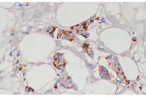 Immunohistochemistry of paraffin-embedded Human mammary cancer using ACSL3 Polyclonal Antibody at dilution of 1:100 (40x lens). (Acsl3 抗体)