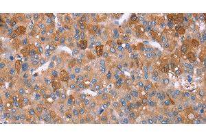 Immunohistochemistry of paraffin-embedded Human liver cancer tissue using GPC6 Polyclonal Antibody at dilution 1:40 (Glypican 6 抗体)
