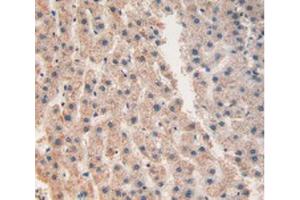 IHC-P analysis of Human Liver Cancer Tissue, with DAB staining. (CHI3L1 抗体  (AA 112-377))