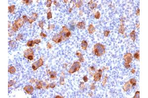 Formalin-fixed, paraffin-embedded human Hodgkin's Lymphoma stained with CD30 Mouse Recombinant Monoclonal Antibody (rKi-1/779).