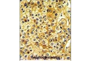 Formalin-fixed and paraffin-embedded human hepatocarcinoma with SRC Antibody , which was peroxidase-conjugated to the secondary antibody, followed by DAB staining. (Src 抗体  (AA 397-424))