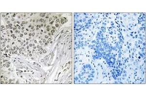 Immunohistochemistry analysis of paraffin-embedded human lung carcinoma tissue, using EFTUD2 Antibody. (EFTUD2 抗体  (AA 321-370))