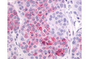 Anti-LPAR4 / GPR23 antibody IHC of human Ovary, Carcinoma. (LPAR4 抗体  (N-Term))