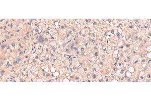 Immunohistochemistry of paraffin-embedded Human liver cancer tissue using RIOK1 Polyclonal Antibody at dilution of 1:80(x200) (RIOK1 抗体)