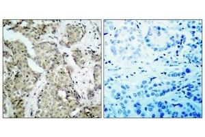 Immunohistochemical analysis of paraffin- embedded human breast carcinoma tissue using MKK6(Phospho-Ser207) Antibody(left) or the same antibody preincubated with blocking peptide(right). (MAP2K6 抗体  (pSer207))