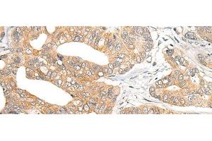 Immunohistochemistry of paraffin-embedded Human gastric cancer tissue using SNX6 Polyclonal Antibody at dilution of 1:40(x200) (SNX6 抗体)