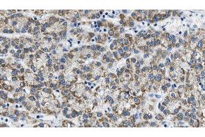 ABIN6275828 at 1/100 staining Human liver cancer tissue by IHC-P. (PIK3 gamma 抗体  (C-Term))