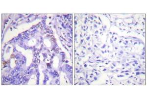 Immunohistochemistry analysis of paraffin-embedded human lung carcinoma tissue using PIAS4 antibody. (PIAS4 抗体  (C-Term))