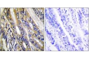 Immunohistochemistry analysis of paraffin-embedded human colon carcinoma tissue, using DGKH Antibody. (DGKH 抗体  (AA 771-820))