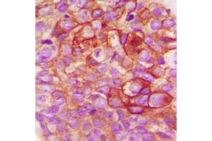 Immunohistochemical analysis of c-SRC staining in human breast cancer formalin fixed paraffin embedded tissue section.