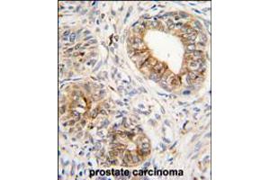 Formalin-fixed and paraffin-embedded human prostata carcinoma tissue reacted with PTGS1 antibody , which was peroxidase-conjugated to the secondary antibody, followed by DAB staining. (PTGS1 抗体  (C-Term))