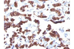 Formalin-fixed, paraffin-embedded human Thyroid Carcinoma stained Thyroglobulin Mouse Monoclonal Antibody (TGB24). (Thyroglobulin 抗体)
