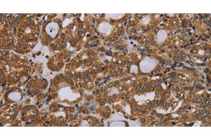 Immunohistochemistry of paraffin-embedded Human thyroid cancer tissue using PARP8 Polyclonal Antibody at dilution 1:40 (PARP8 抗体)