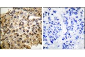 Immunohistochemistry analysis of paraffin-embedded human breast carcinoma tissue, using p44/42 MAPK Antibody. (ERK1/2 抗体  (AA 330-379))