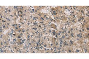 Immunohistochemistry of paraffin-embedded Human liver cancer using ESRRG Polyclonal Antibody at dilution of 1:30 (ESRRG 抗体)