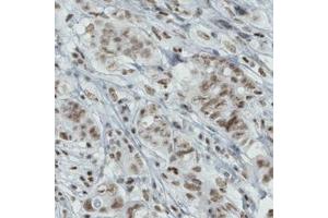 Immunohistochemical staining (Formalin-fixed paraffin-embedded sections) of human breast cancer with BRD4 monoclonal antibody, clone CL1115  shows moderate nuclear immunoreactivity in tumor cells. (BRD4 抗体)