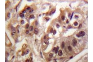 Immunohistochemistry analyzes of IKKγ antibody in paraffin-embedded human breast carcinoma tissue. (IKBKG 抗体)