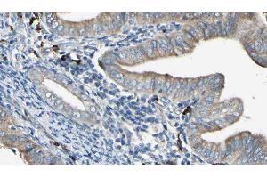 ABIN6277956 at 1/100 staining Human cervical cancer tissue by IHC-P. (SOAT1 抗体  (Internal Region))