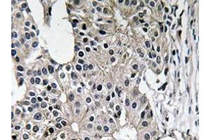 Immunohistochemistry analyzes of Caspase-7 antibody in paraffin-embedded human breast carcinoma tissue. (Caspase 7 抗体)