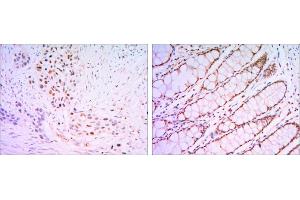Immunohistochemical analysis of paraffin-embedded lung cancer tissues (left) and human rectum tissues (right) using KLF4 antibody with DAB staining. (KLF4 抗体)