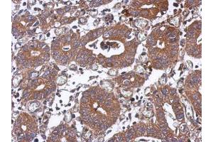 IHC-P Image Immunohistochemical analysis of paraffin-embedded human colon carcinoma, using PPM1J, antibody at 1:500 dilution. (PPM1J 抗体)