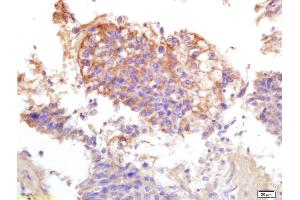 Formalin-fixed and paraffin embedded human lung carcinoma labeled with Anti-Phospho-ATP1A1(Tyr10) Polyclonal Antibody, Unconjugated (ABIN683173) at 1:200 followed by conjugation to the secondary antibody and DAB staining. (ATP1A1 抗体  (pTyr10))