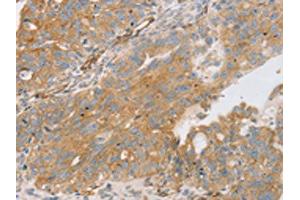 The image on the left is immunohistochemistry of paraffin-embedded Human breast cancer tissue using ABIN7131237(STX16 Antibody) at dilution 1/30, on the right is treated with fusion protein. (Syntaxin 16 抗体)
