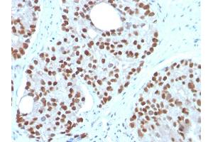 Formalin-fixed, paraffin-embedded human Prostate Carcinoma stained with NKX3. (NKX3-1 抗体  (AA 92-224))
