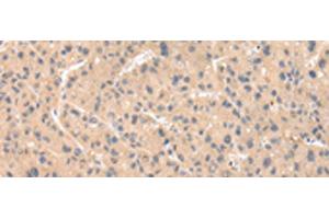 Immunohistochemistry of paraffin-embedded Human liver cancer tissue using ZNF268 Polyclonal Antibody at dilution of 1:50(x200) (ZNF268 抗体)