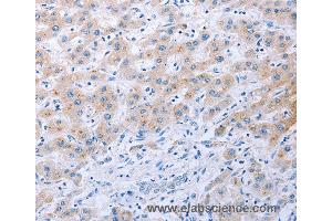 Immunohistochemistry of Human thyroid cancer using FGF4 Polyclonal Antibody at dilution of 1:40 (FGF4 抗体)