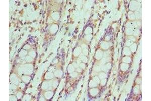 Immunohistochemistry of paraffin-embedded human colon cancer using ABIN7156622 at dilution of 1:100 (IRF4 抗体  (AA 180-451))