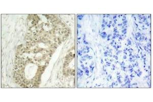 Immunohistochemical analysis of paraffin-embedded human breast carcinoma tissue using PKCd(Phospho-Ser645) Antibody(left) or the same antibody preincubated with blocking peptide(right). (PKC delta 抗体  (pSer645))