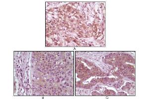 Immunohistochemical analysis of paraffin-embedded human pancreas carcinoma (A), esophagus carcinoma tissue (B) and ovary tumor tissue, showing cytoplasmic and membrane localization using 4E-BP1 mouse mAb with DAB staining. (eIF4EBP1 抗体)