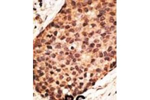 Formalin-fixed and paraffin-embedded human cancer tissue reacted with the primary antibody, which was peroxidase-conjugated to the secondary antibody, followed by AEC staining. (MMP16 抗体  (N-Term))