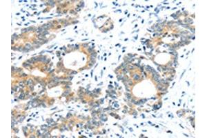 The image on the left is immunohistochemistry of paraffin-embedded Human colorectal cancer tissue using ABIN7192957(TUSC1 Antibody) at dilution 1/30, on the right is treated with synthetic peptide. (TUSC1 抗体)