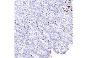 Abundant helicobacter pylori in a case of gastritis (Helicobacter Pylori 抗体  (AA 323-445))