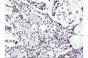 Immunohistochemical staining of paraffin-embedded Adenocarcinoma of Human colon tissue using anti-NLN mouse monoclonal antibody. (NLN 抗体)