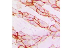 Immunohistochemical analysis of Paxillin staining in human breast cancer formalin fixed paraffin embedded tissue section.