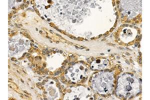 DRP1 Mouse Monoclonal Antibody at 1/100 staining human ovarian cancer by IHC-P. (Dynamin 1-Like 抗体  (C-Term))