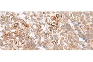 Immunohistochemistry of paraffin-embedded Human ovarian cancer tissue using MCAM Polyclonal Antibody at dilution of 1:40(x200) (MCAM 抗体)