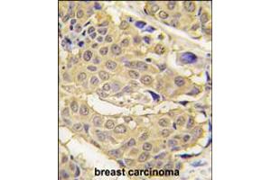 Formalin-fixed and paraffin-embedded human breast carcinoma tissue reacted with EPRS antibody , which was peroxidase-conjugated to the secondary antibody, followed by DAB staining. (EPRS 抗体  (N-Term))