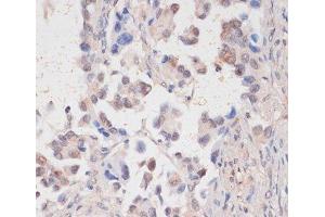 Immunohistochemistry of paraffin-embedded Human lung cancer using HTATSF1 Polyclonal Antibody at dilution of 1:100 (40x lens). (HTATSF1 抗体)