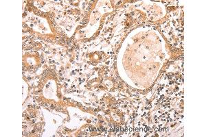 Immunohistochemistry of Human liver cancer using ABCF1 Polyclonal Antibody at dilution of 1:40 (ABCF1 抗体)
