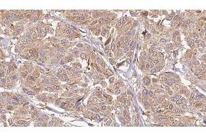 ABIN6276604 at 1/100 staining Human Melanoma tissue by IHC-P. (LCN6 抗体  (Internal Region))