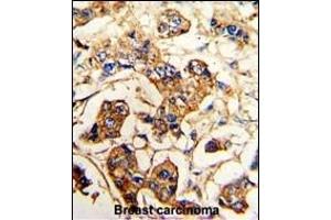 Formalin-fixed and paraffin-embedded human breast carcinoma reacted with ACTN4 Antibody (C-term), which was peroxidase-conjugated to the secondary antibody, followed by DAB staining. (alpha Actinin 4 抗体  (C-Term))