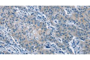 Immunohistochemistry of paraffin-embedded Human gastric cancer tissue using GAS2 Polyclonal Antibody at dilution 1:50 (GAS2 抗体)